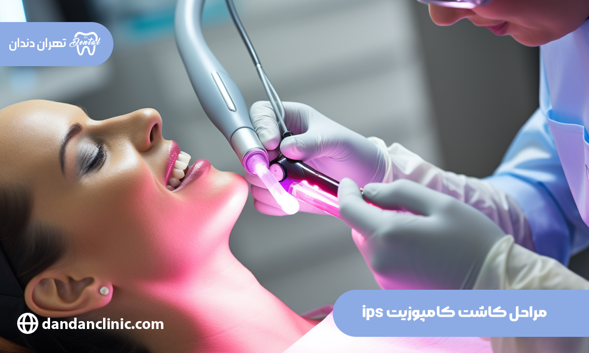 کامپوزیت ips؛ احیای درخشندگی و استحکام بالای دندان و رفع نواقص